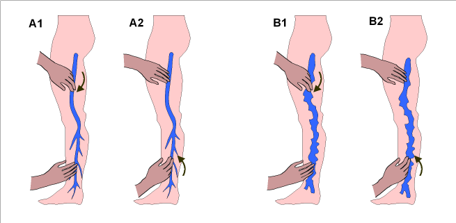 Le moyen efficace du psoriasis